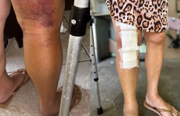 Erro médico: idosa tem prótese posta em joelho errado